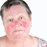 Rosacea Rosacea